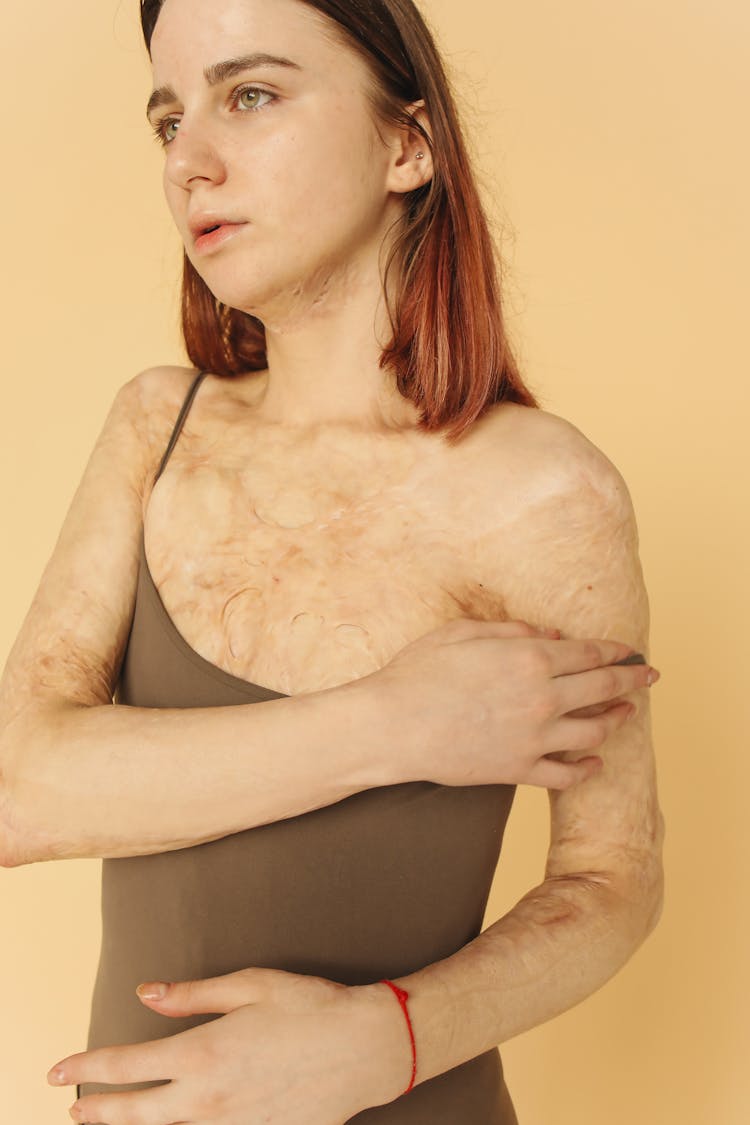 Brunette Woman Showing Burned Scars On Her Body And Arm