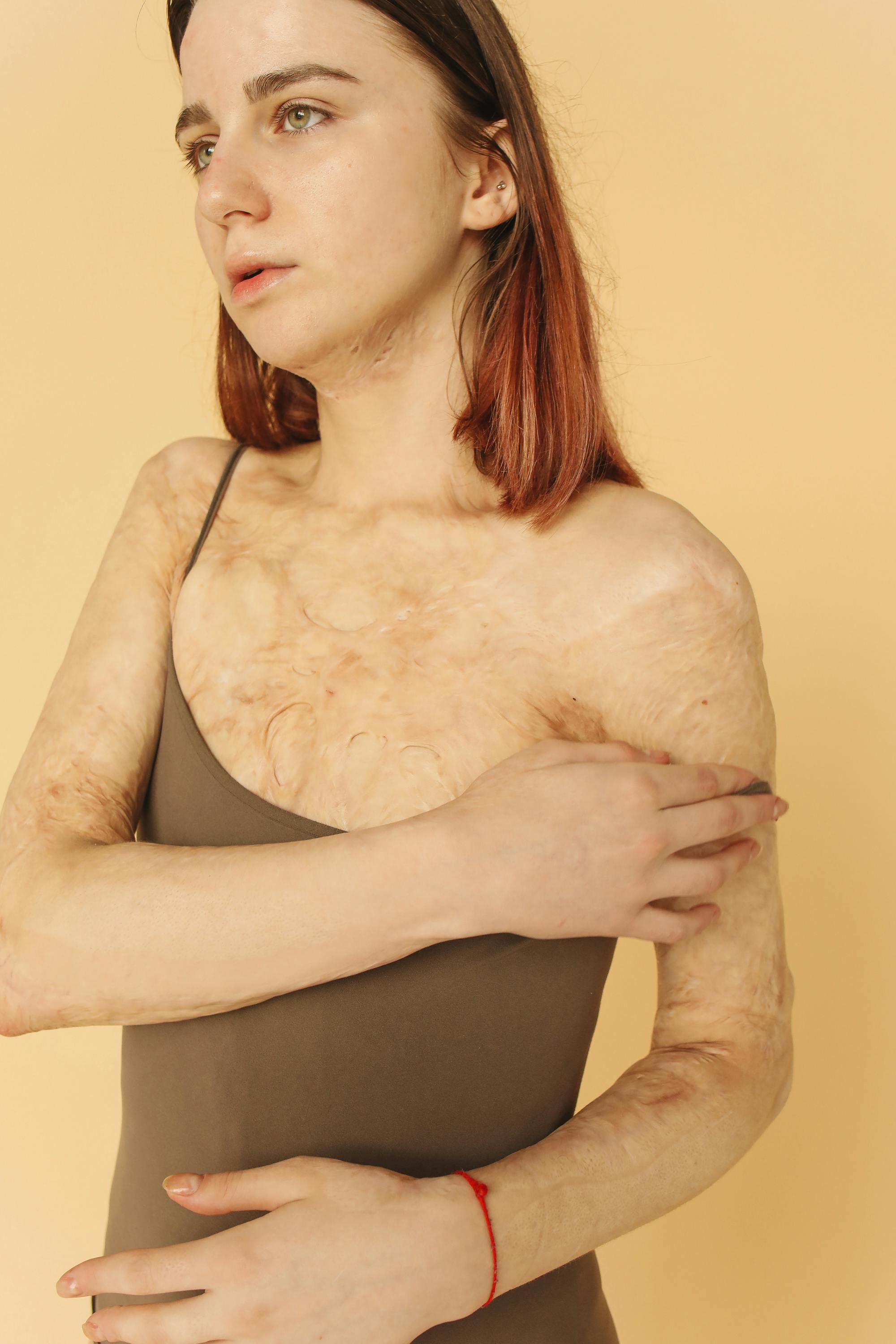 Woman Shows Burn On Her Chest Stock Photo 2321983571