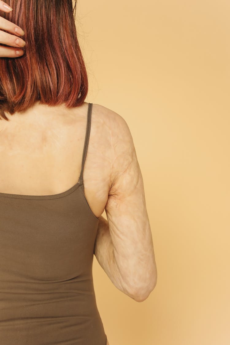 Unrecognizable Redhead Woman Showing Arm With Burn Scars