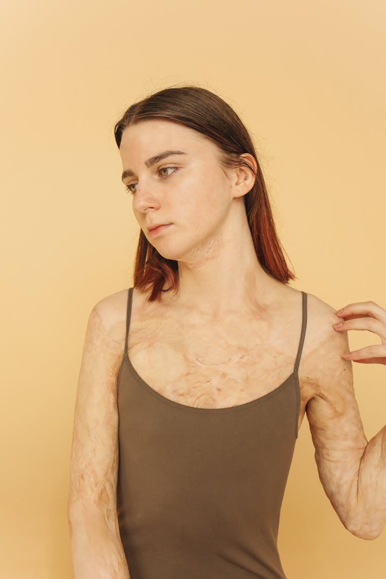 A Woman With Burn Scars On Her Skin