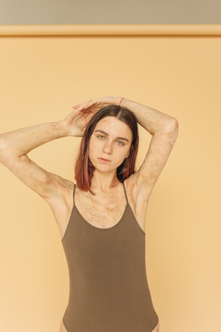 A Woman In Brown Swimwear With Burn Scars On Her Skin