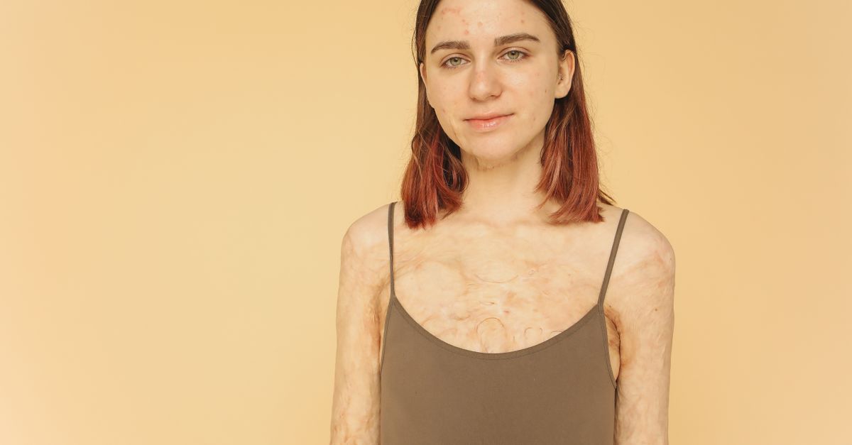 What Is Skin Cancer
