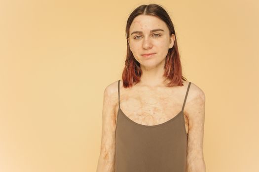 一名年轻女子留着烧伤疤痕，在米色背景下自信地微笑着