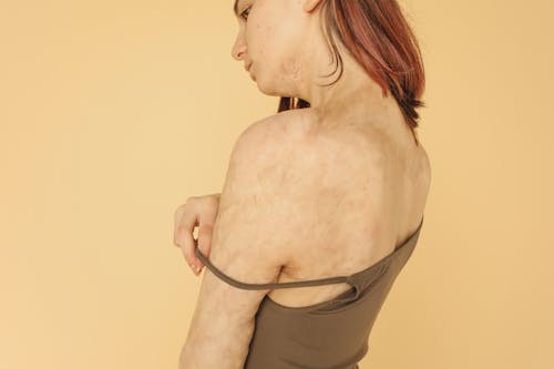 A Woman in Brown Top with Skin Burns
