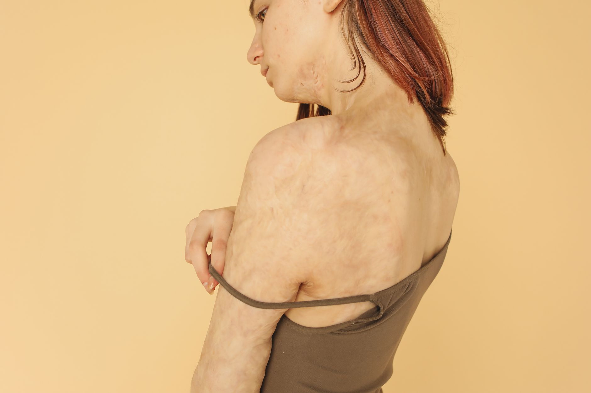 Lebrikizumab maintains atopic dermatitis remission for months off-therapy