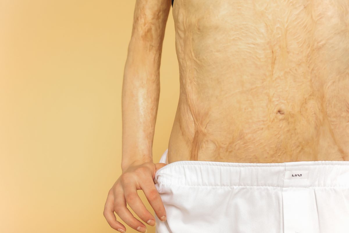 Stretch Mark Treatment treatment at a MedSpa