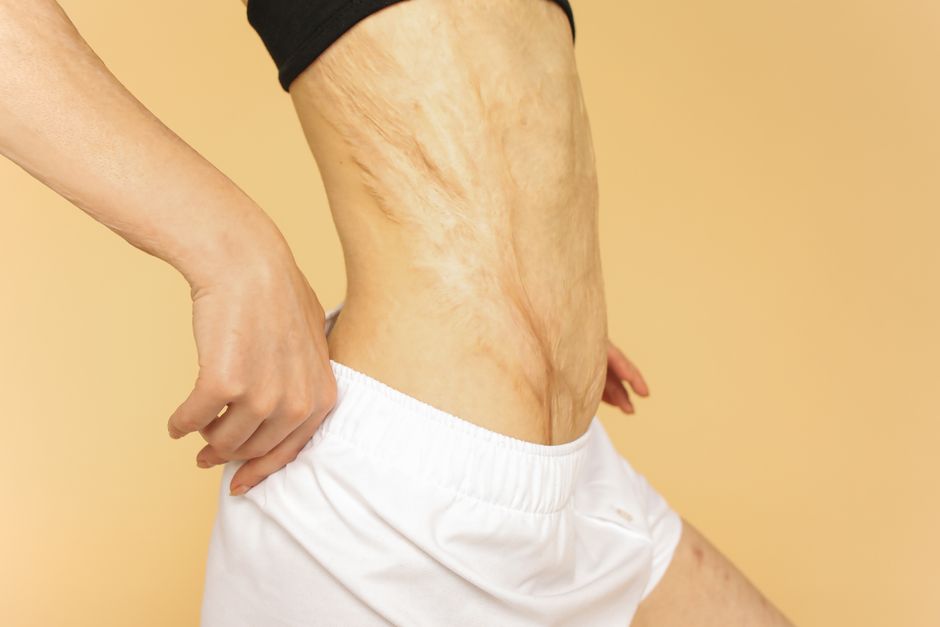 Healed Nipple Reduction Scars - nipple reduction Healed Nipple Reduction Scars - nipple reduction