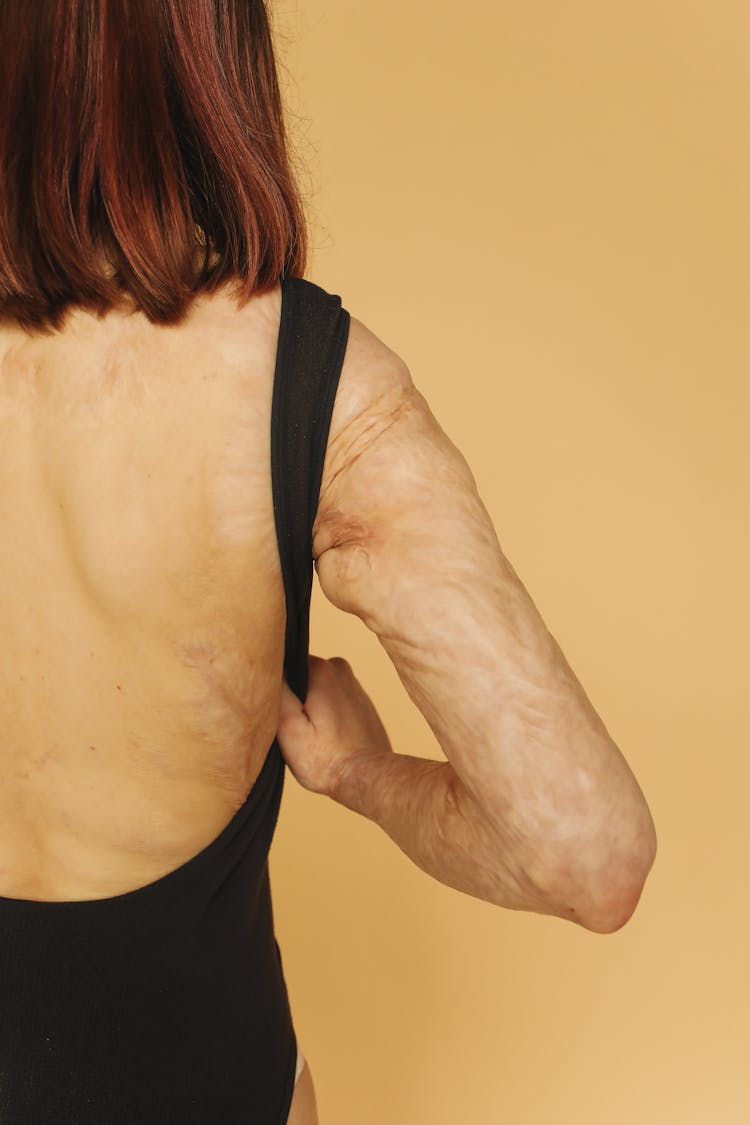 Woman With Recovered From Skin Burn 