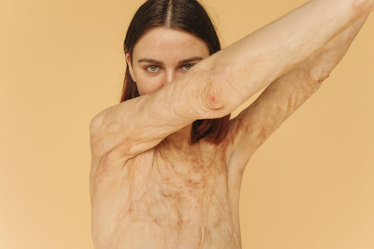 Brunette Woman Shirtless Showing Burned Scars On Her Body