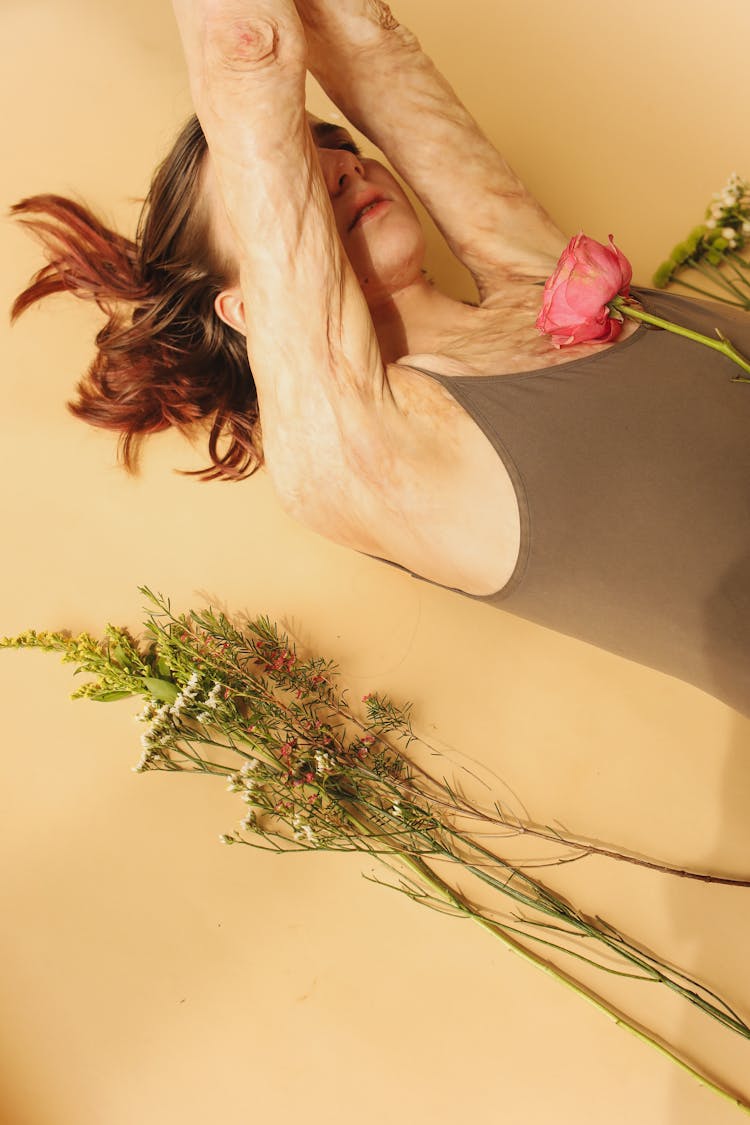 Skin Burn Survivor Woman Posing With Flowers