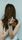dandruff