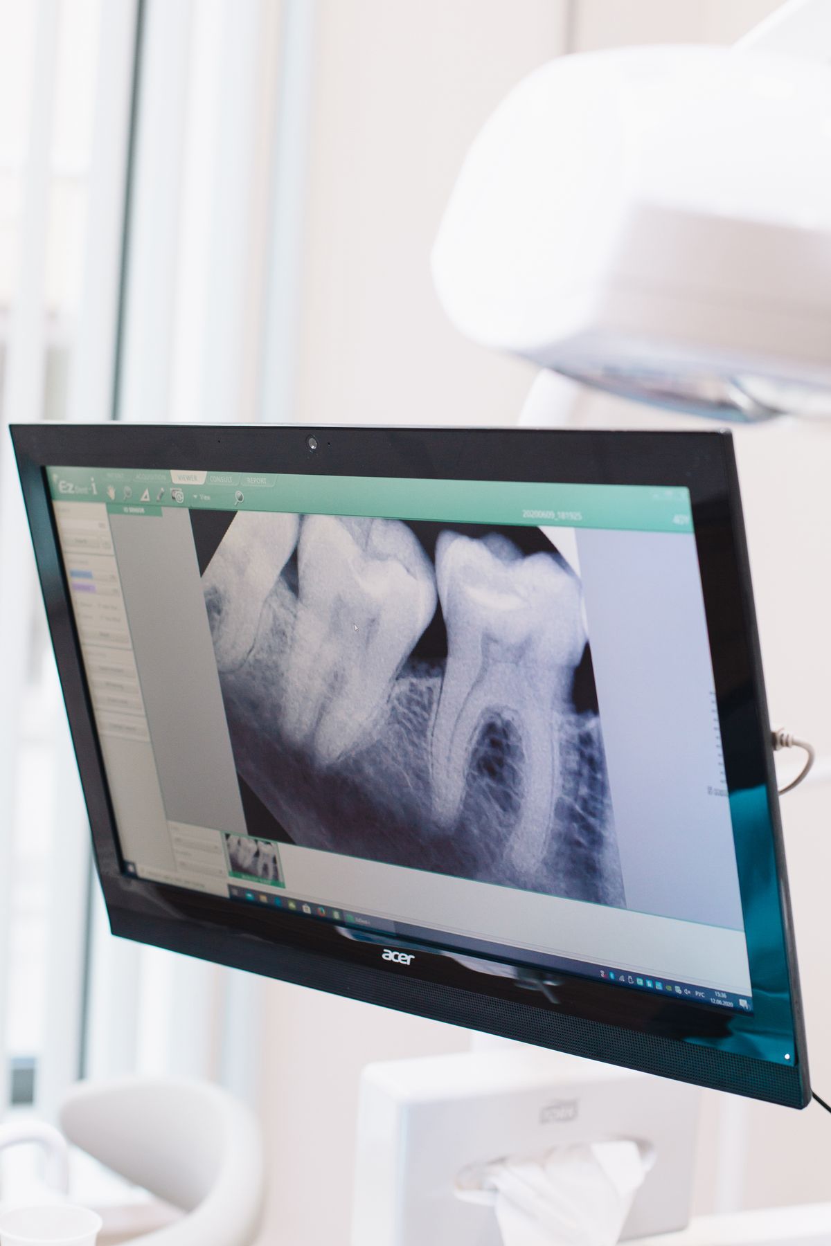 AI-assisted X-ray analysis on a chairside monitor