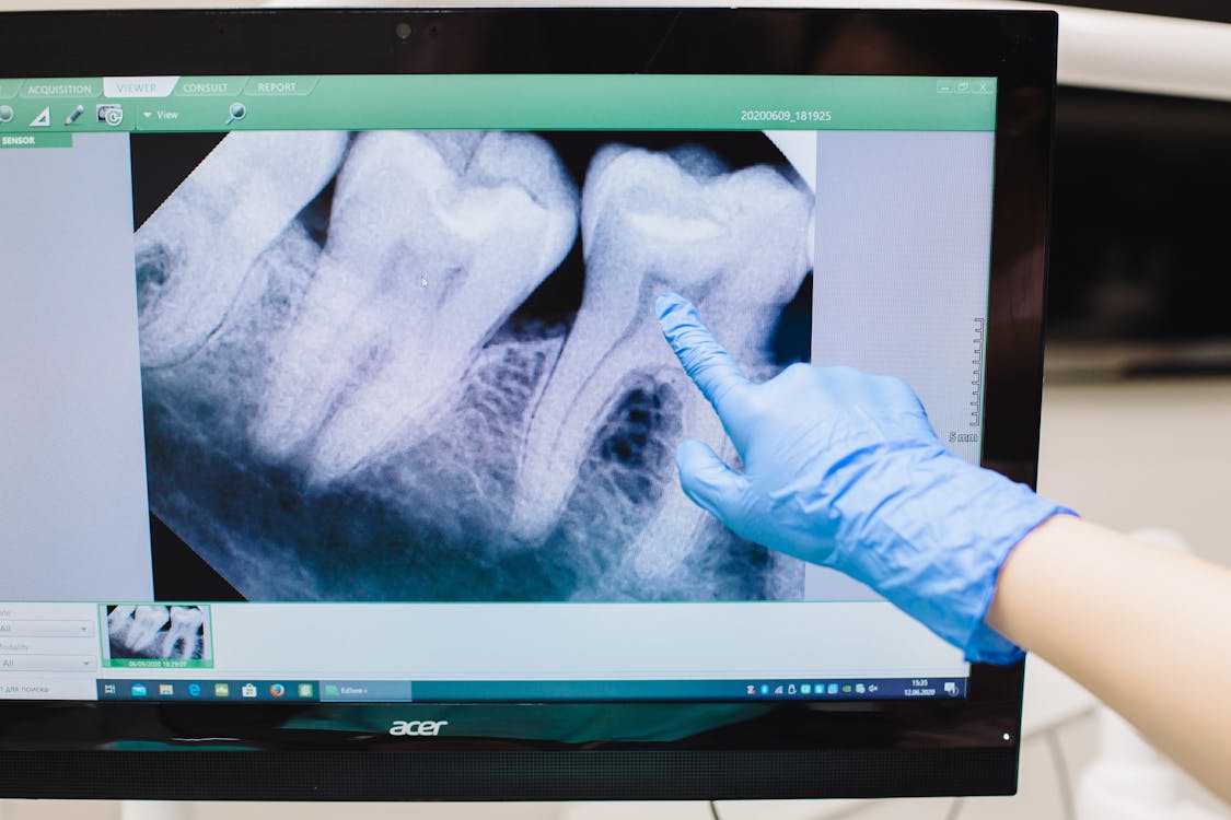 Entenda como funciona a expansão maxilar com aparelho - DVI Radiologia