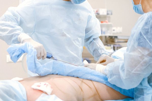 Buttock Implants