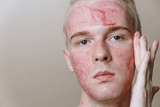 壬二酸产品示例及其对色素沉着和炎症的作用路径