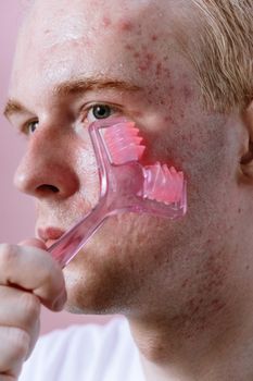 A detailed close-up of a man using a pink skincare roller on his acne-prone face showcasing self-care routines.