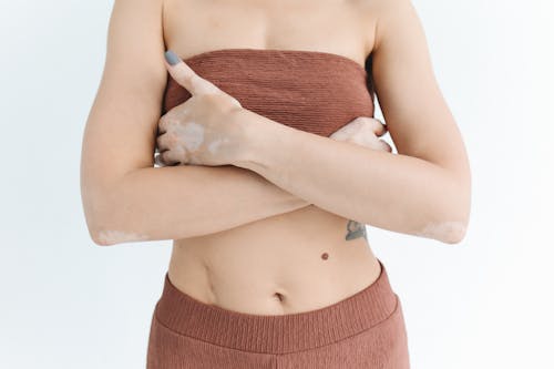 Free Woman with Vitiligo in Nude Colored Underwear Stock Photo
