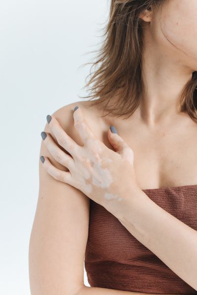 Vitiligo