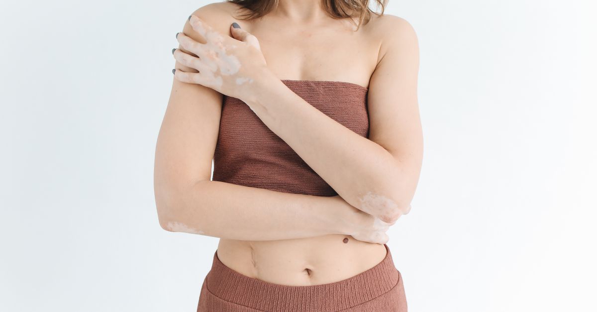 Rare Skin Reaction Linked to HIV Treatment in Patient Case Study