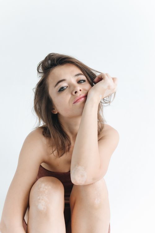 Free Beautiful brunette woman with vitiligo sitting in thoughtful pose against a white background. Stock Photo