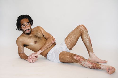 Free Young ethnic man with vitiligo in underwear lying on floor Stock Photo