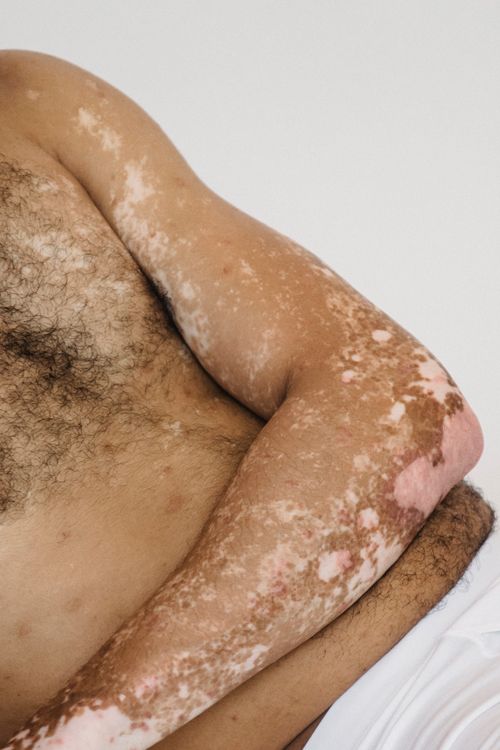 Free Crop anonymous male with naked torso living with vitiligo lying on floor against white wall during photo session Stock Photo