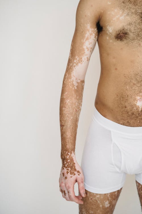 Crop unrecognizable male wearing white underpants living with vitiligo condition standing against white wall in light studio