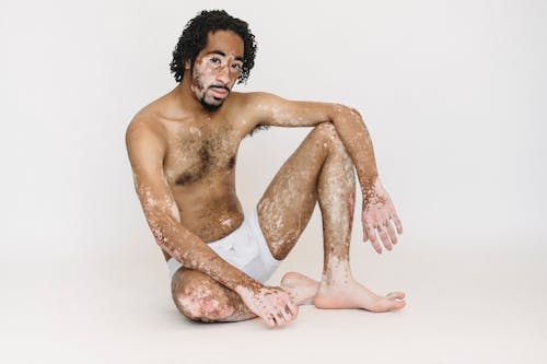 Black man in underpants living with vitiligo sitting on floor