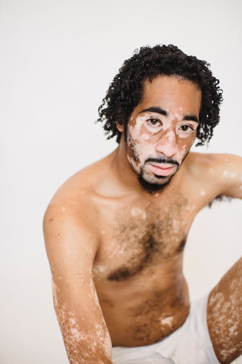 Contemplative African American male with naked torso living with vitiligo condition sitting on floor in light studio and looking at camera pensively