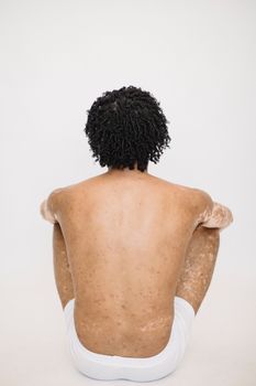工作室里，一个患有白癜风的男人光着膀子，平静而沉思地拥抱自己的独特性