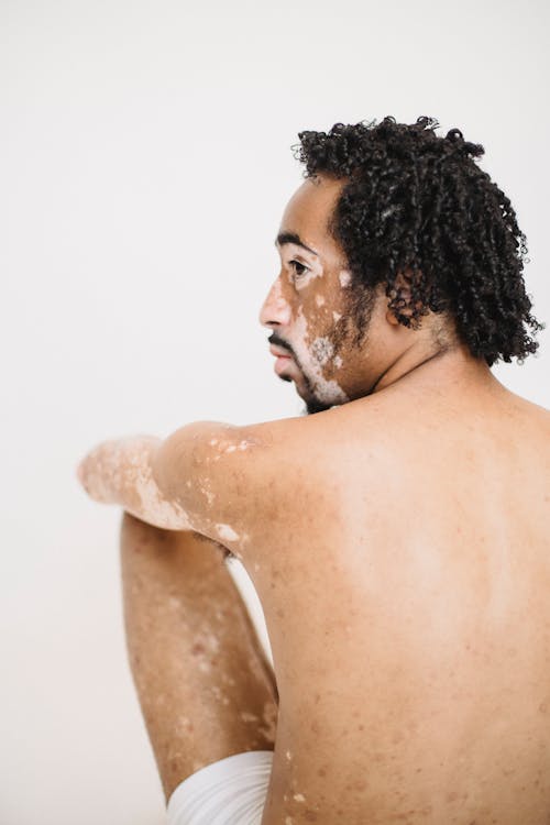Back view shirtless African American male in white underpants living with vitiligo condition sitting on floor and embracing knees against white wall in studio and looking away