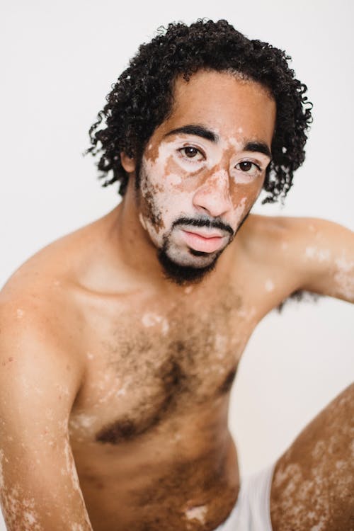 Young unshaven African American male with patchy skin sitting with naked torso and looking at camera on white background