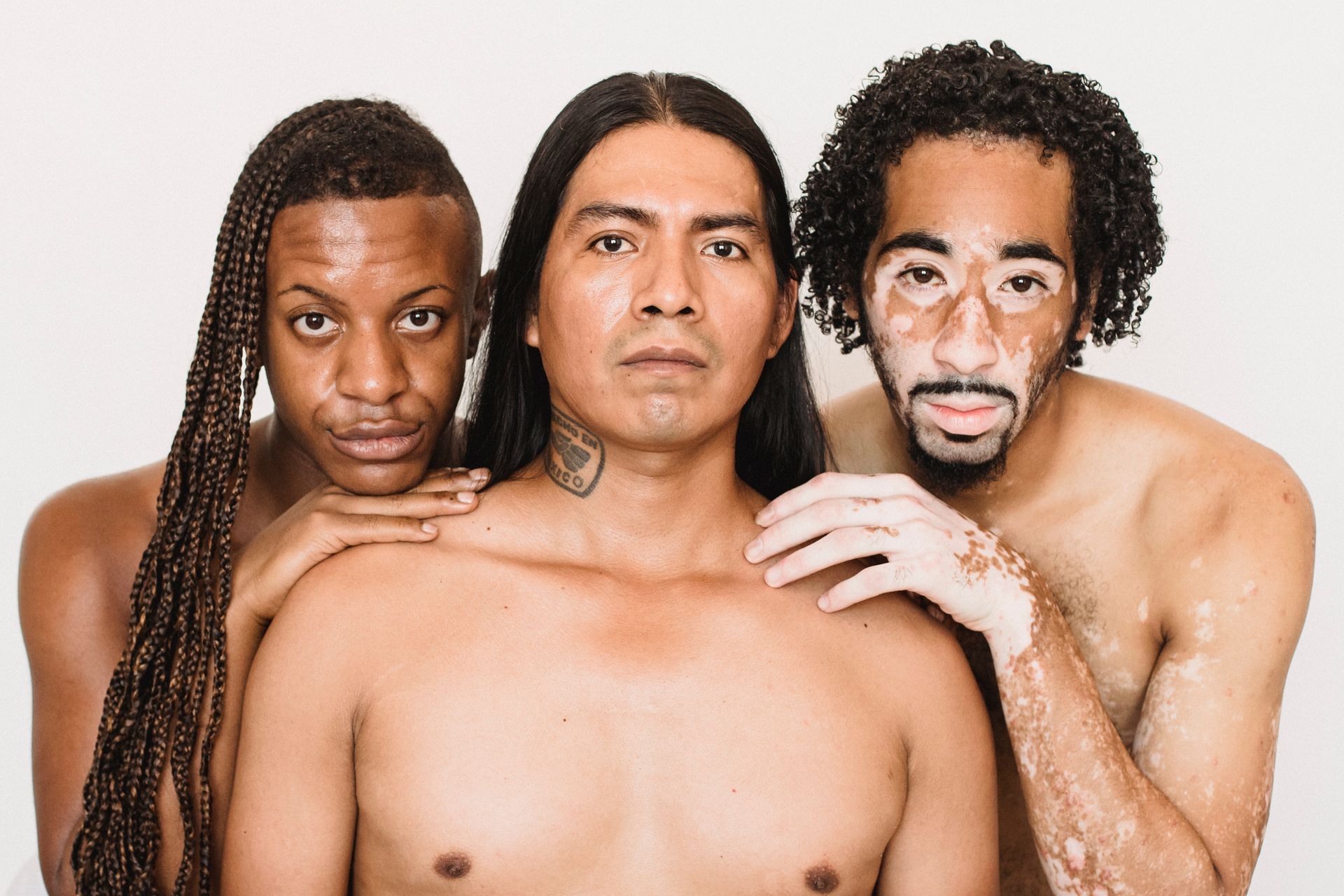 Young black man with vitiligo skin condition standing close to partner with Afro braids and serious ethnic friend while looking at camera