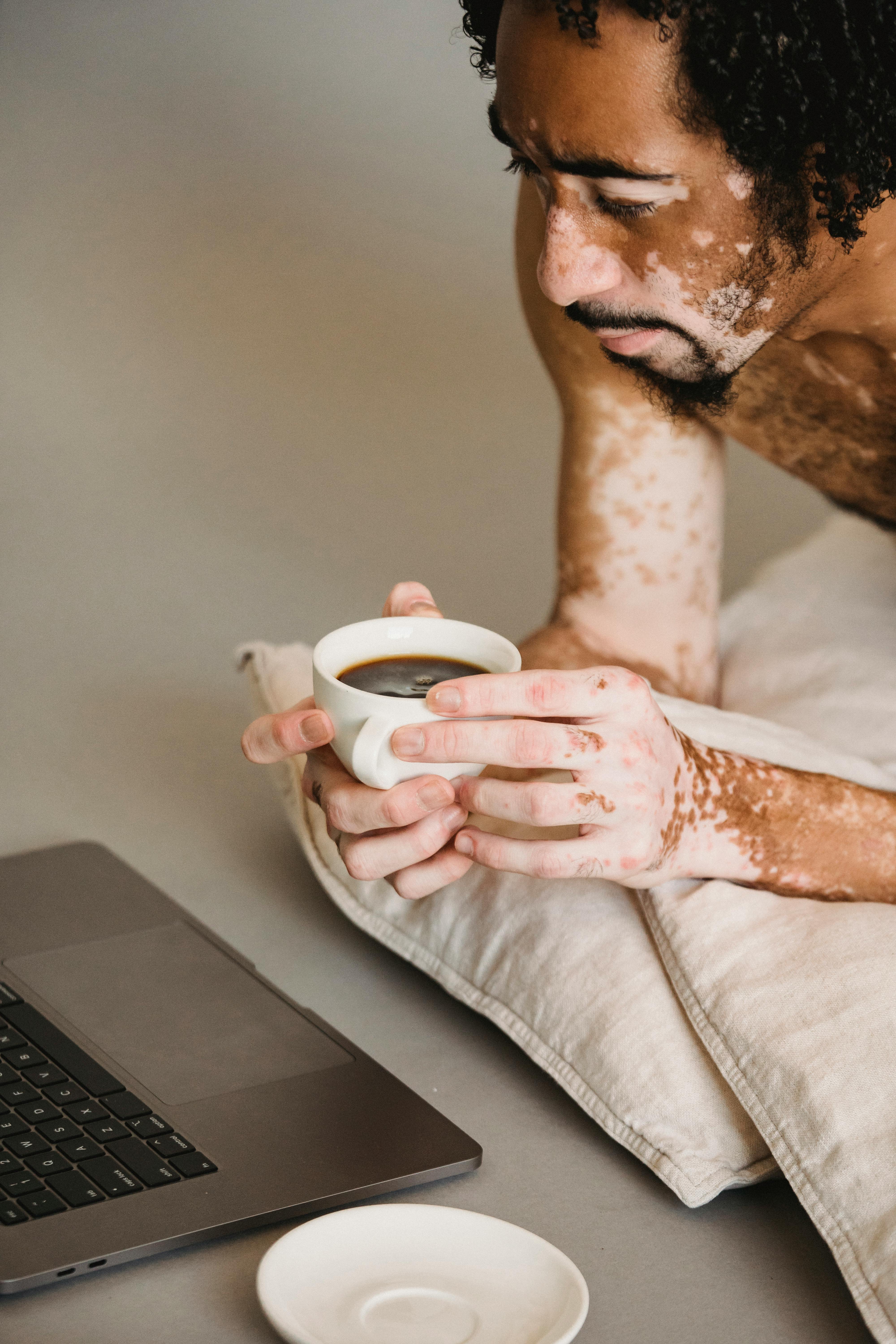 Young man with vitiligo having a cup of coffee in a cafeteria