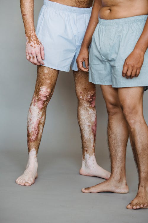 Free Crop unrecognizable shirtless man in boxer shorts living with vitiligo skin standing near man in underwear in light studio Stock Photo