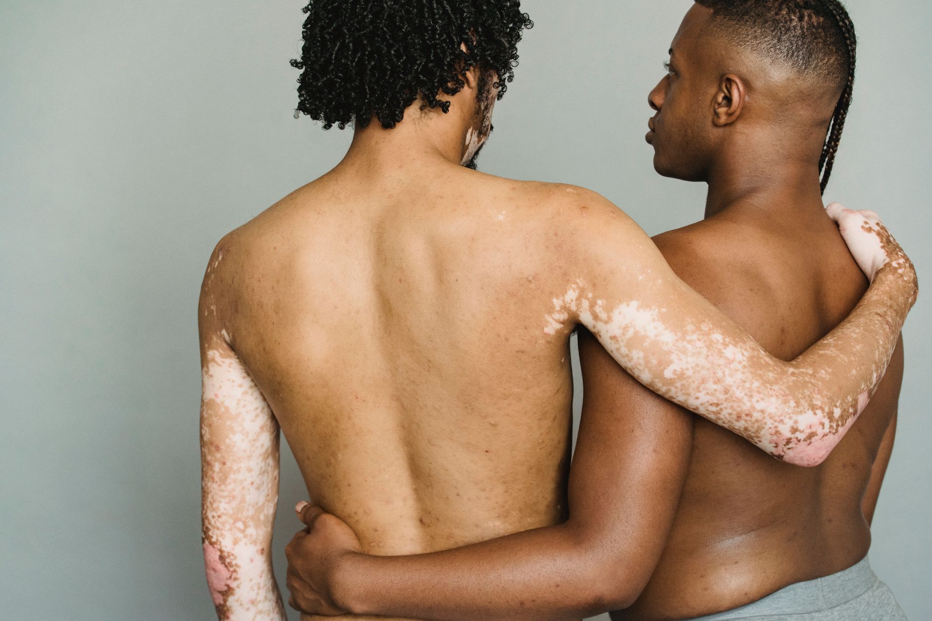 Understanding Vitiligo: Beyond the Skin, Addressing the Stigma
