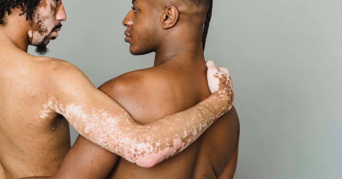 When Does Psoriasis Turn Into Psoriatic Arthritis