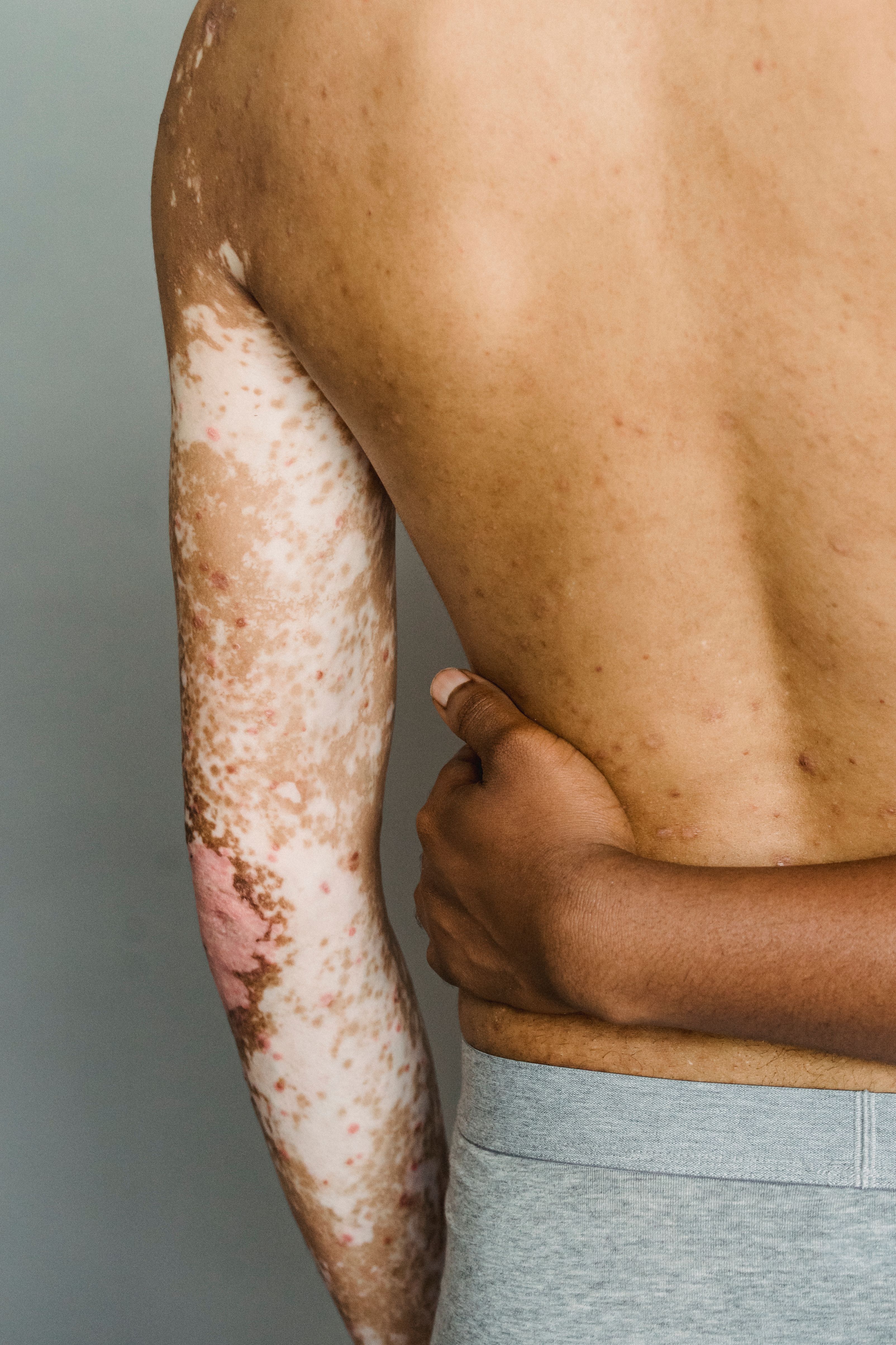 Psoriatic Spondylitis (M07.2): Pemahaman Komprehensif tentang Spondilitis Psoriatik