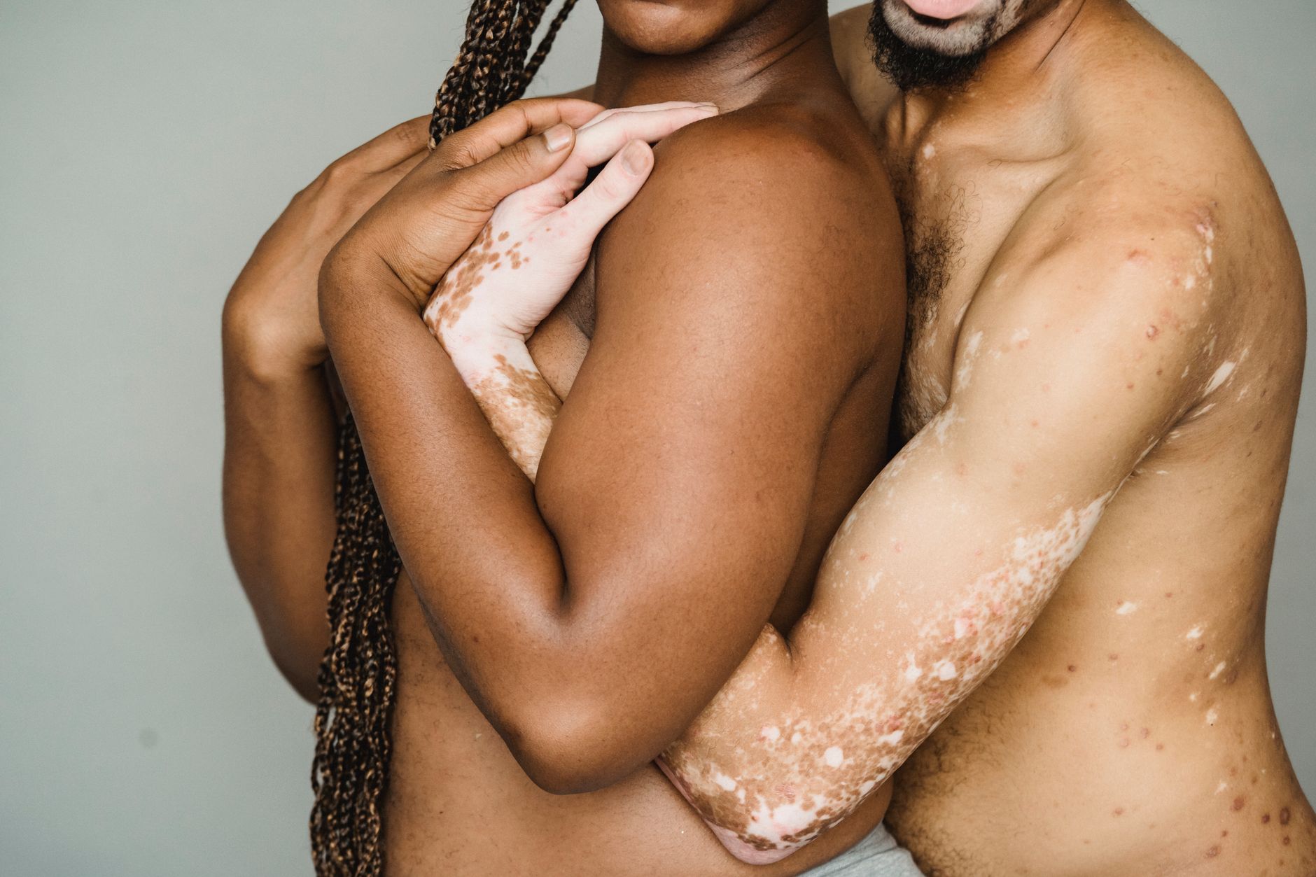 Psoriasis: How it Affects Women Differently Than Men