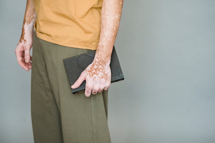 Man With Vitiligo Standing With Notebook