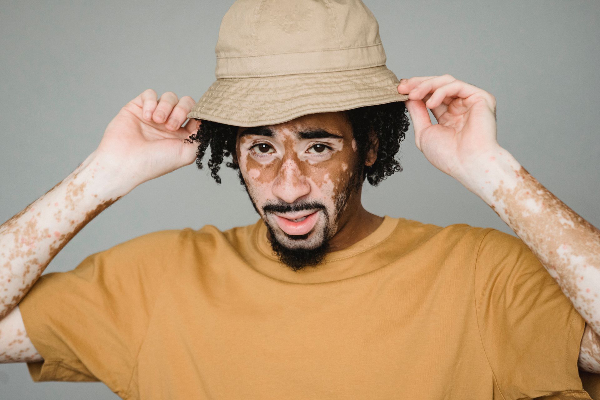 Young African American male with vitiligo patches putting on headgear while representing unique appearance in studio