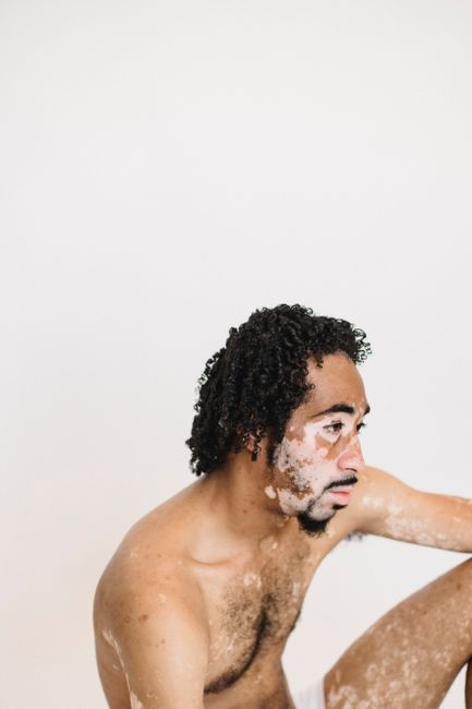 Side view of a thoughtful man with a skin condition, capturing natural beauty and health themes.
