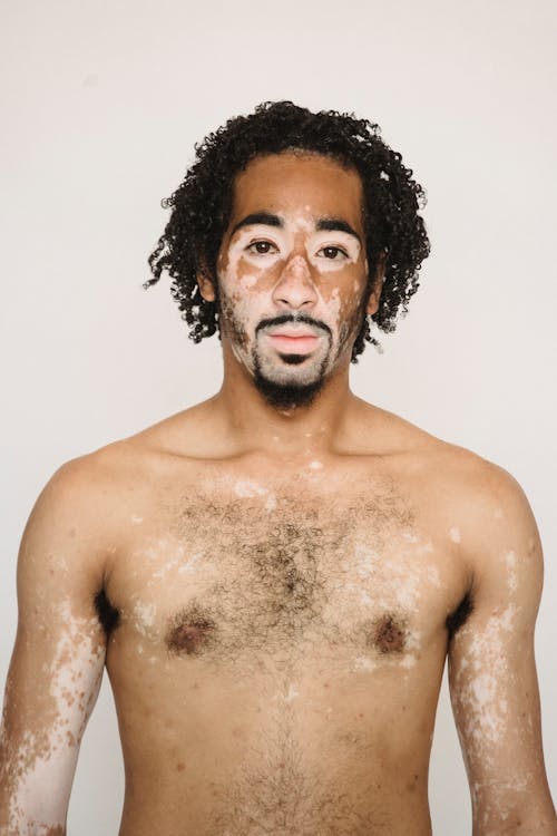 Homem Negro Com Vitiligo Contra Fundo Branco