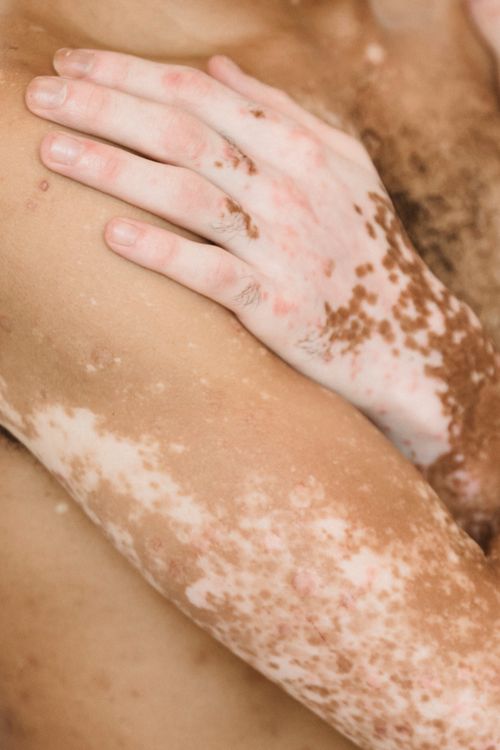 Free Body of unrecognizable male with naked torso and loss of skin color with white patches standing with hand on shoulder Stock Photo