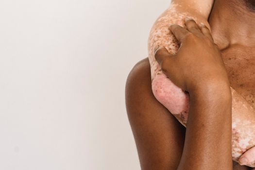 Unrecognizable man with skin disease hugging anonymous African American male with naked torso while standing against white background in studio