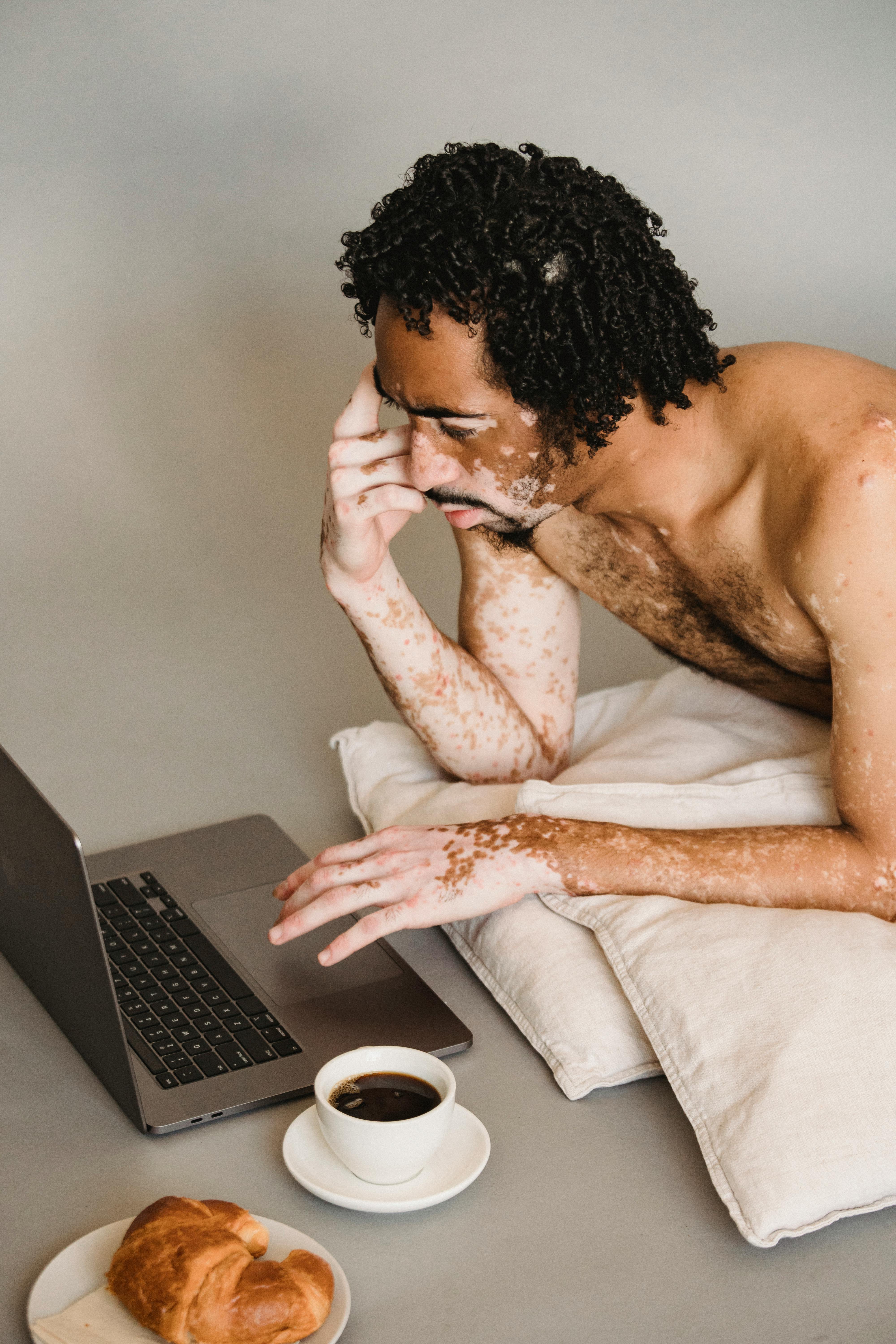 Young man with vitiligo having a cup of coffee in a cafeteria