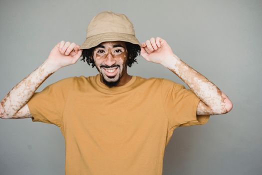 Content African American male living with psoriasis in casual shirt putting on summer hat and looking at camera with smile