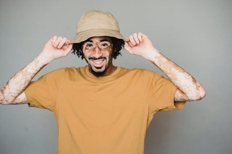 Cheerful Black Man With Vitiligo Skin Putting On Summer Hat