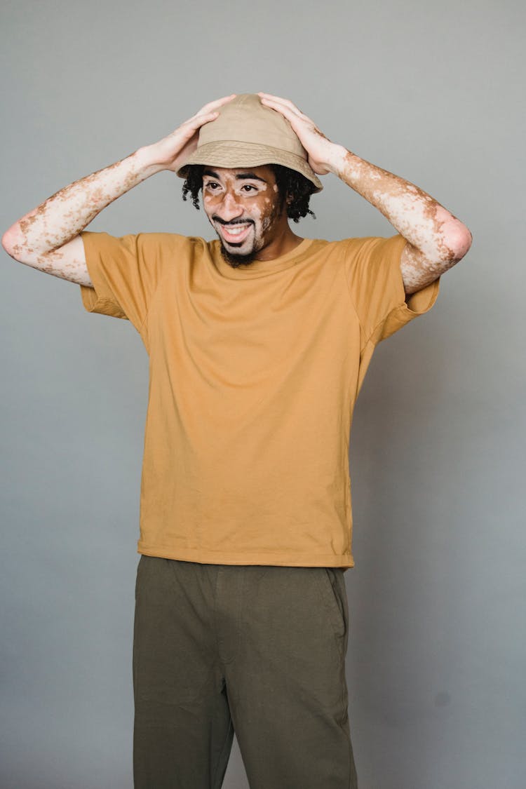 Cheerful Black Man With Vitiligo Putting On Hat