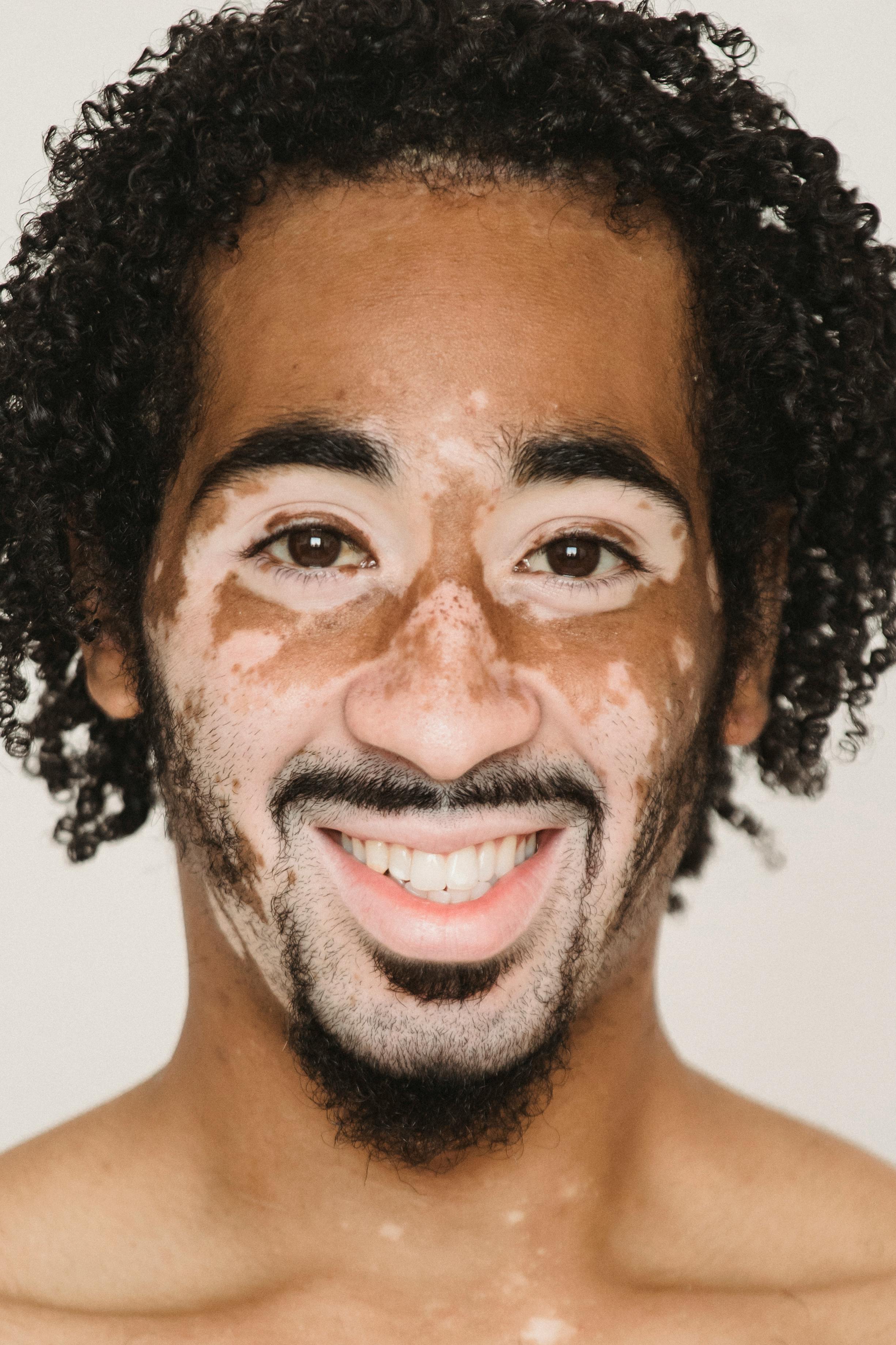 cheerful black man with vitiligo skin